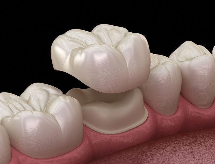 A dental crown fitted over a prepared tooth