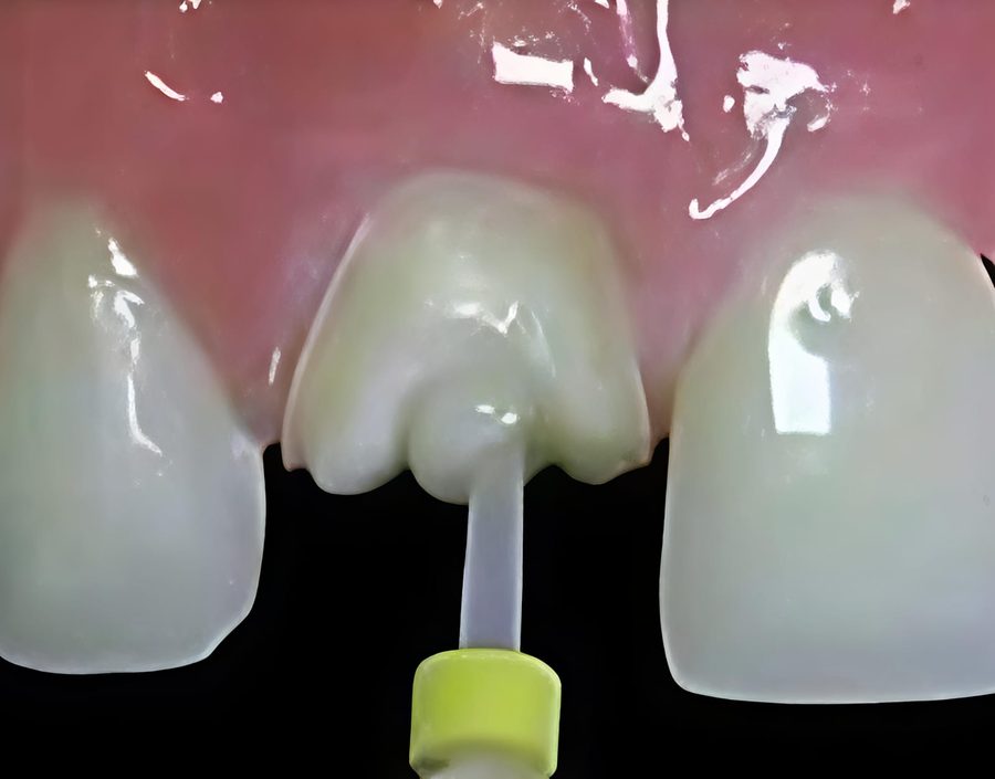 A post placed inside a tooth to support a crown