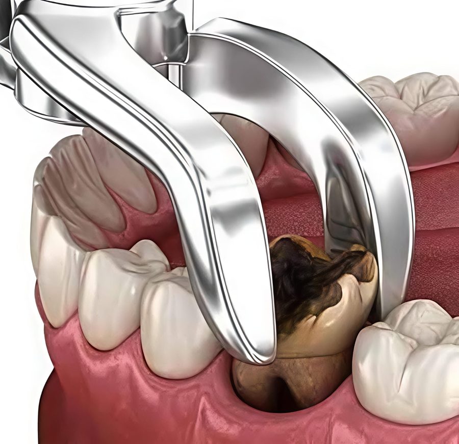 Dental instruments positioned for a tooth extraction
