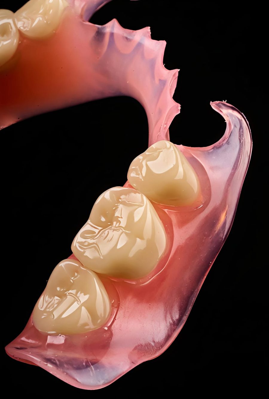 A removable partial denture replacing several missing teeth