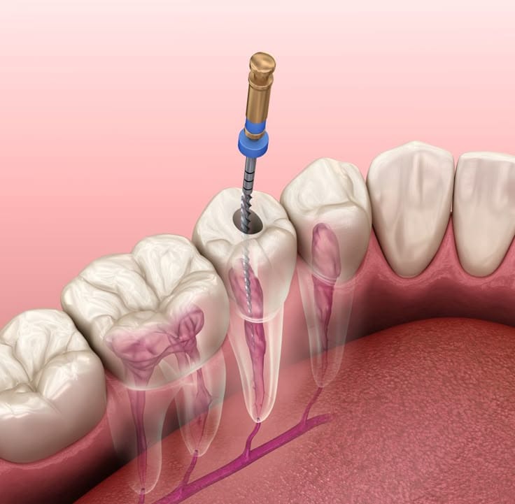 An endodontic file inside a tooth during root canal treatment